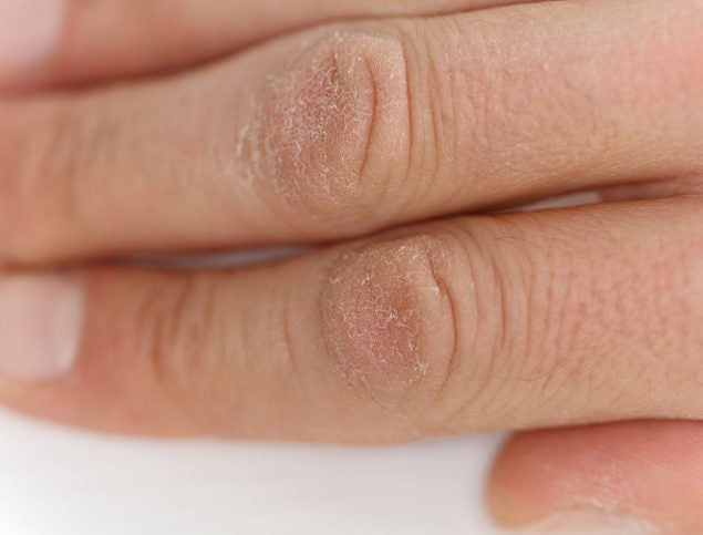 Winter Dry and Cracked Skin Blues - Tierra Mia Organics